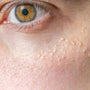 Let’s Talk Milia: What Are They & How To Prevent Them