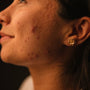 Why You Really Shouldn’t Pop Your Pimples (But What To Do If You Just Did)