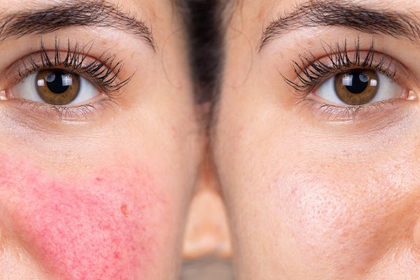 What's the Best Foundation for Covering Rosacea?