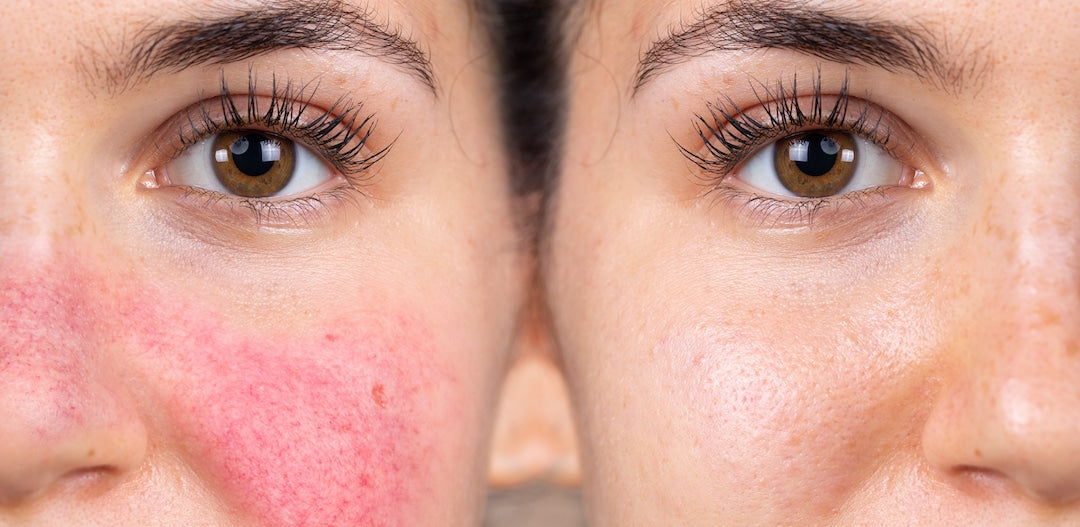 What's the Best Foundation for Covering Rosacea?